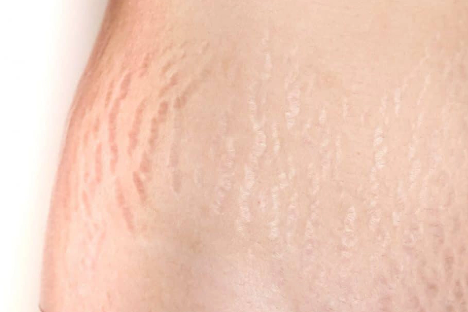 solutions for stretch marks at almoosa clincs